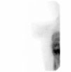 Gamma Lesion